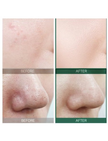 Serum Equilibrante Piel Grasa Some By AHA BHA PHA 30 Days Miracle Serum