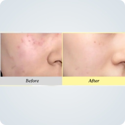 Emulsiones y Cremas al mejor precio: Crema regenerante Post-acné Dr. Althea 345 Relief Cream de Dr. Althea en Skin Thinks - Piel Sensible